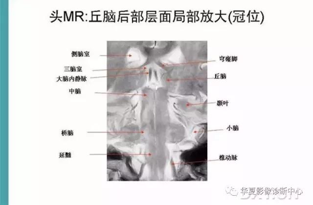 电子版头颅ct与mri断层解剖,头颅mri血管解剖与分段详解