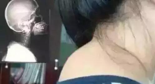 颈椎包夺命包富贵包,颈椎富贵包怎么解决