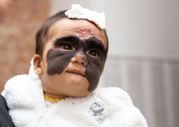 女婴脸上有胎记做了手术恢复了,女婴面部黑色胎记像蝙蝠侠面罩