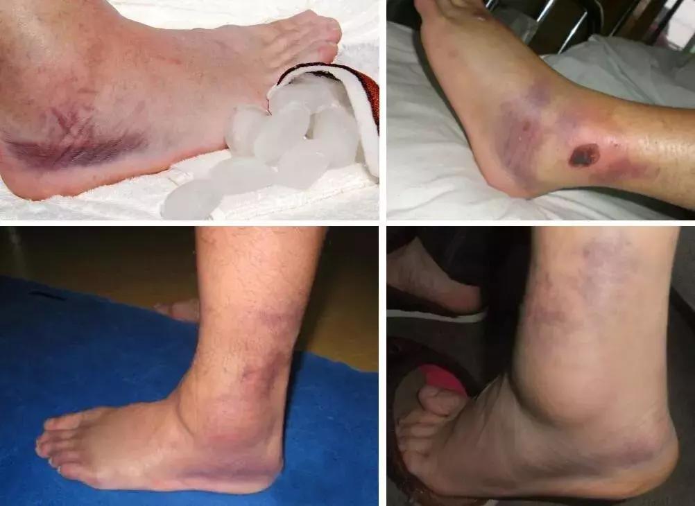 跑步大腿疼和小腿疼有什么区别,跑步之后脚跟疼怎么回事