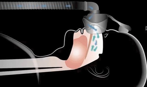 睡眠呼吸机工作原理动画演示,睡眠呼吸机治疗打鼾的原理