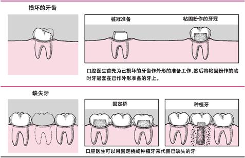 上门牙缺失3颗做牙桥修复方案,缺牙缝隙大能做固定桥修复吗