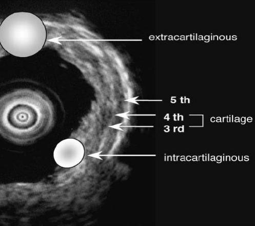 支气管镜高频电刀治疗中央型肺癌,支气管镜在早期肺癌诊断的意义