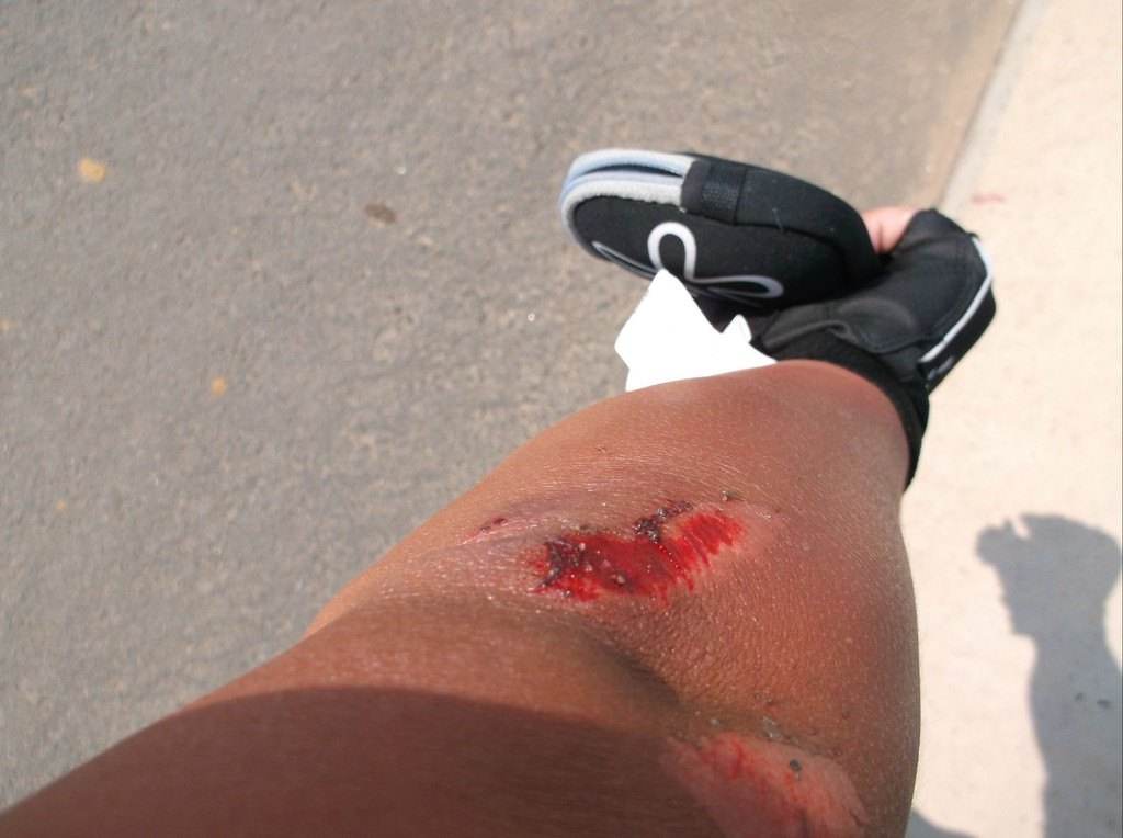 小磕小碰、摔伤烧伤在所难免,不想去医院,在家如何安全处理?