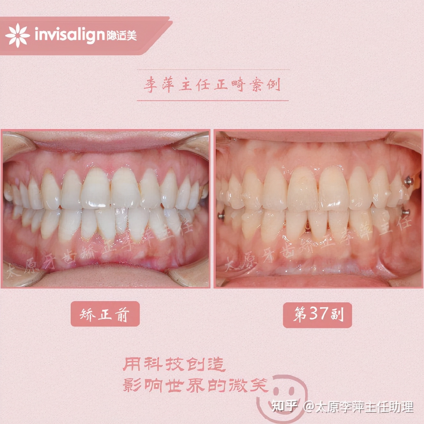 太原牙齿矫正靠谱吗,太原成人隐形牙套牙齿不齐