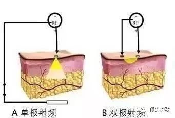 射频仪器对人体的伤害,射频仪危害