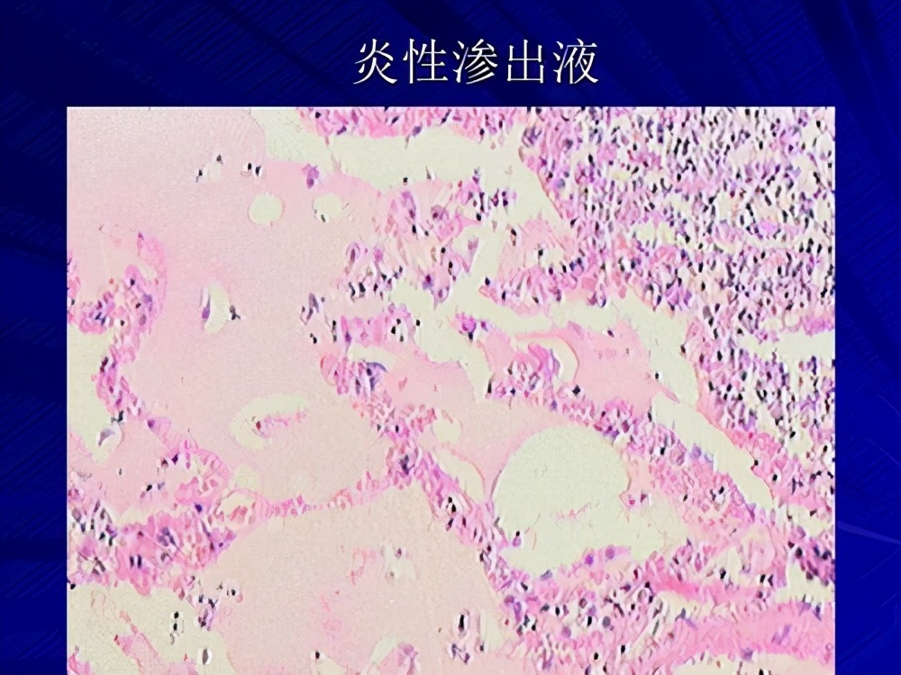 化脓性汗腺炎是什么引起的,化脓性汗腺炎是怎么引起的