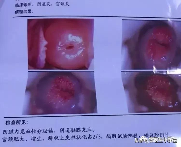 tct检查出血和医生技术有关系吗,做完tct检查怎么就出血了怎么止血