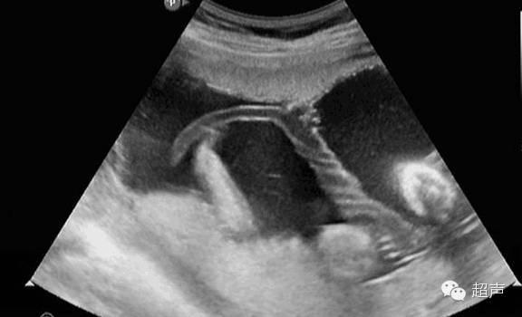 帆状胎盘变普通胎盘,帆状胎盘是由啥原因导致的