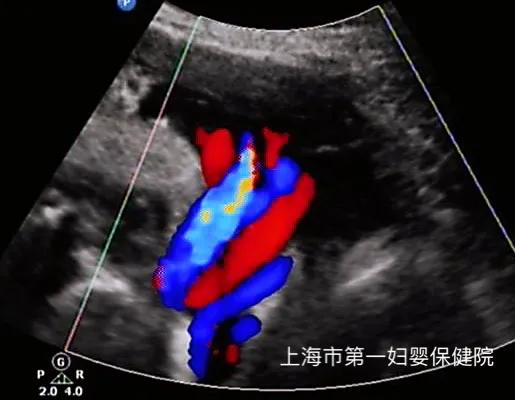 脐带绕颈导致孩子窒息医院责任,孕期脐带绕颈3周会窒息吗