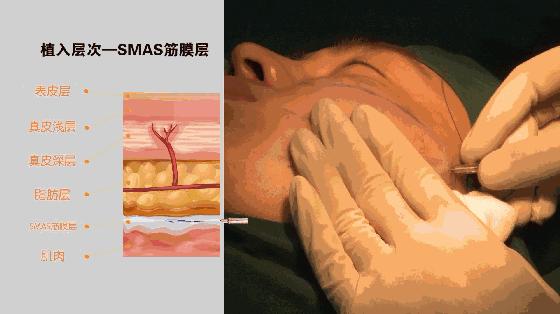 做完线雕半个月脸还是肿痛，是正常现象吗?知道的谈一谈