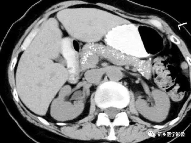 腹部平片可以看出肠胃疾病吗,腹部散在结节状高密度影