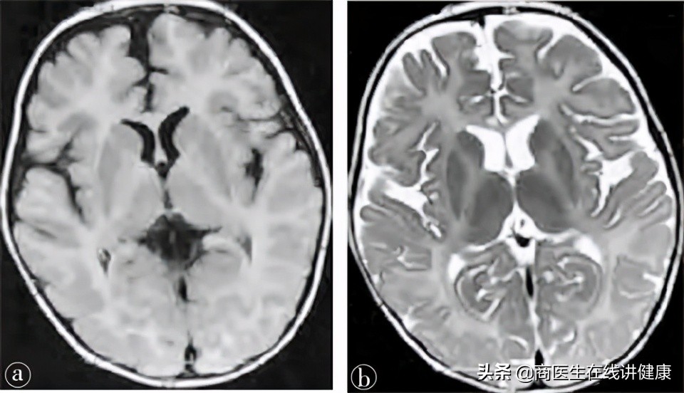 佩梅病临床治疗,佩梅病病情发展