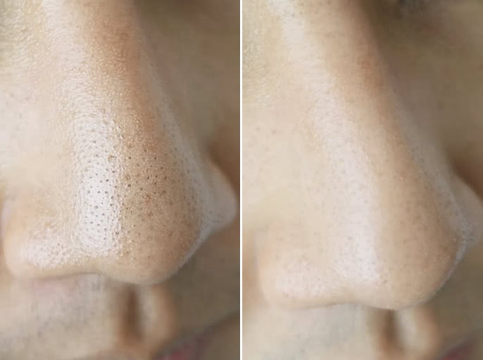 微针美容是否适合你一份详细指南,毛孔粗痘坑用什么微针精华