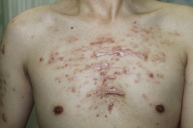 胸口上的疤痕疙瘩长大了,胸口疤痕疙瘩越长越大怎么办