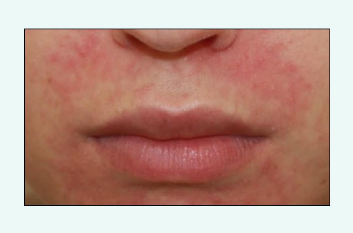 脸上的红疙瘩怎么彻底消除,脸上红疙瘩的种类