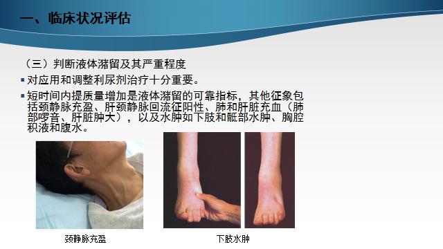 慢性心衰治疗的五个步骤,慢性心衰的诊断标准