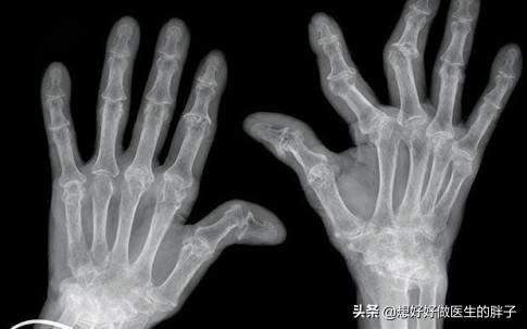 膝盖有骨刺自我疗法,膝盖有骨刺的物理治疗