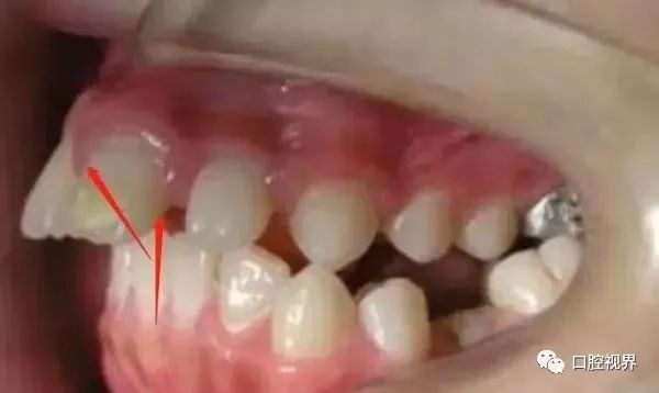 听说牙缝太大难看又露财，您给看看这牙缝还有救吗？