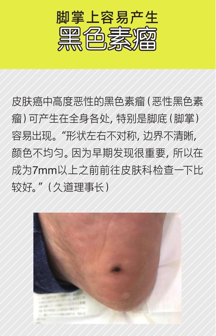 脚底的老茧怎么才能根治,老茧下的鸡眼