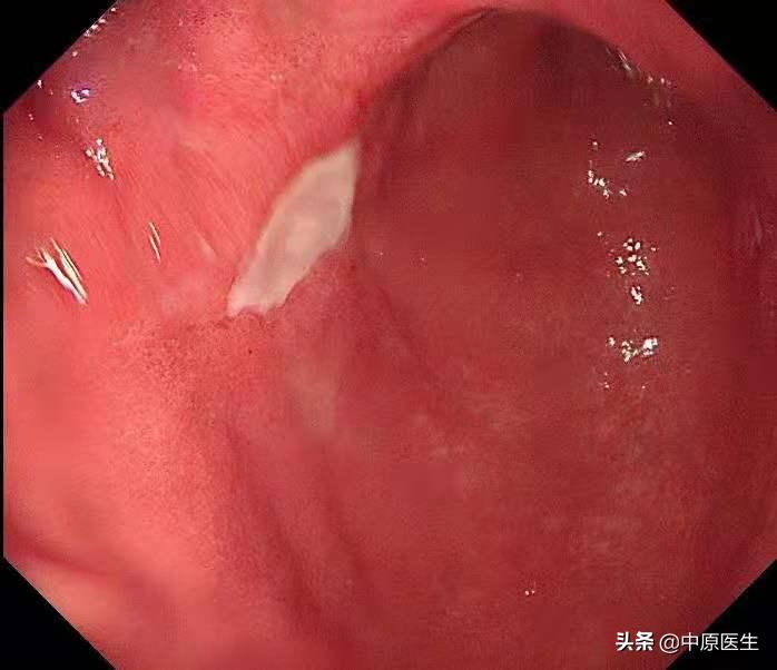 胃部怀疑是溃疡，细心专家又选择窄带光放大检查发现是胃癌