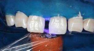 门牙缝可以补吗,为什么门牙有缝