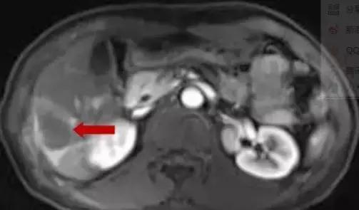 直肠癌病例分享,直肠癌肝转移做射频消融动画演示