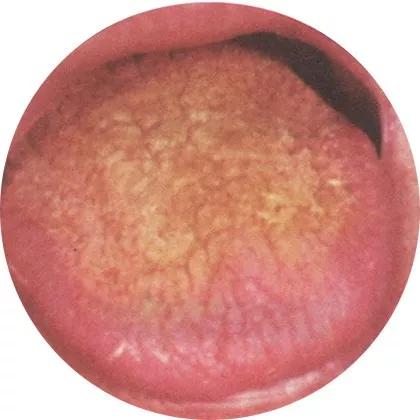 胃强脾弱积食内热,体内有热吃点什么