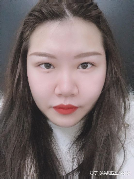 胖妹妹适合割双眼皮吗,胖女孩割双眼皮