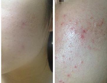 下巴反复长痘痘的原因和解决方法,下巴老是长痘痘怎么调理身体啊