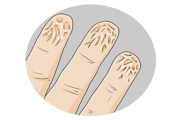 游泳久了手指皱皮,游泳时间长手指出现褶皱怎么回事