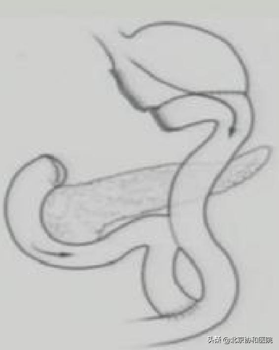 北京协和医院基本外科张太平,北京协和医院张太平手术水平