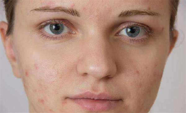 鼻子上痘印消不掉怎么办,青春期痘痘密集痘印消不掉怎么办