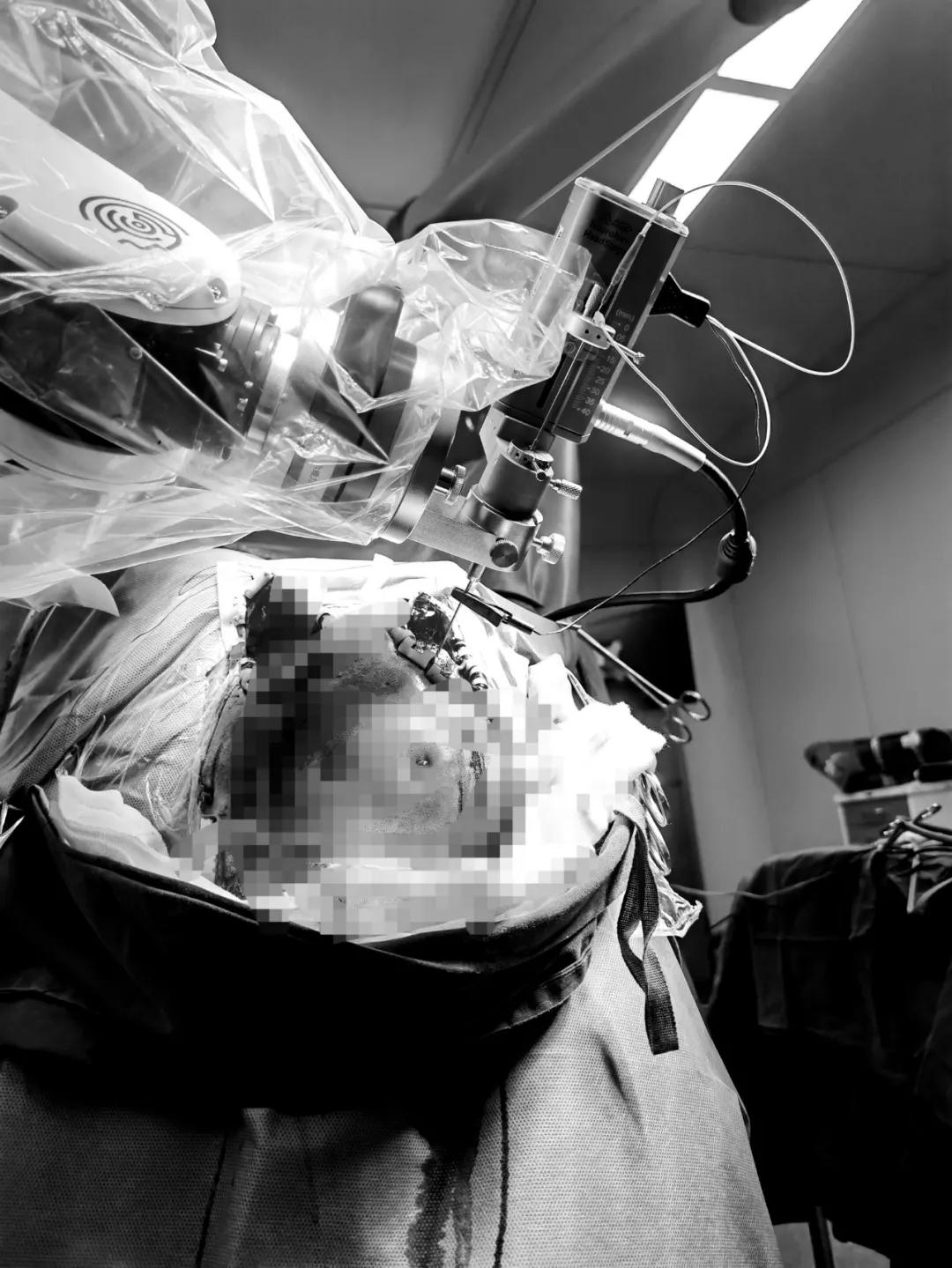 脑深部电刺激技术,中国首例脑深部电刺激手术