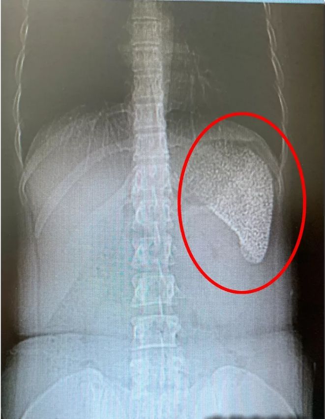 女孩脾脏被异物塞得密密麻麻...医生切开后，吓出一身鸡皮疙瘩！