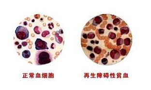 血液病再障有哪些症状,血液病患者如何预防出血