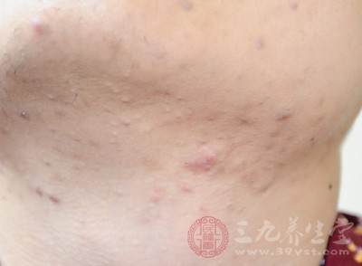 脖子上长痘痘的原因及解决方法,脖子上长了很多痘痘什么原因