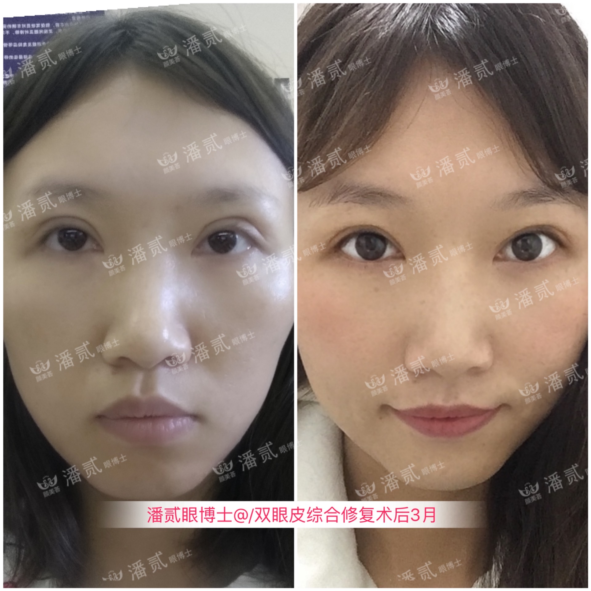 高难度修复双眼皮宽改窄恢复期,高难度双眼皮修复案例