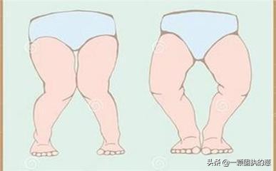 新生儿有o型腿是什么原因造成的,一岁2个月宝宝o型腿绑腿多久能好
