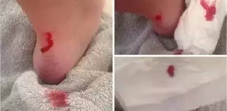 为什么女生的脚后跟那么容易磨破,脚后跟的心酸血泪史