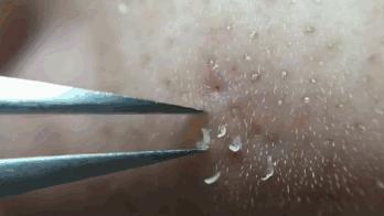 画面极度舒适！十几年顽固老黑头，30秒彻底连根拔起！毛孔畅快呼吸原来是这种感觉