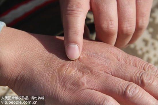 网红祛疤膏真的有效吗,网红祛疤痕膏