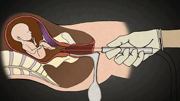 多次打胎真实案例,25岁女生接受多少次打胎