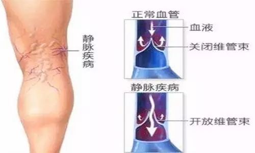 预防腿部静脉曲张最好的方法,静脉曲张的六个误区