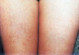 鸡皮肤解决方法又白又嫩学生适用,鸡皮肤太丑了该怎么办