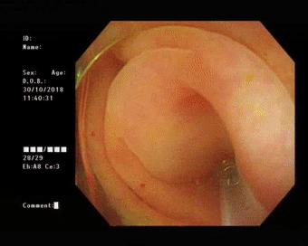 治疗阑尾炎需要手术吗,阑尾炎为什么选择保守治疗呢