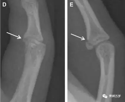 肩关节脱位易漏诊的骨折,放射科容易漏诊的骨折