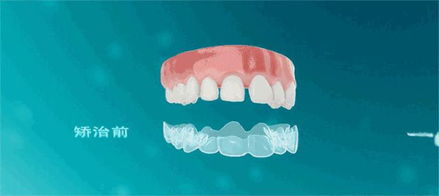 再等几天,江西人矫正牙齿、种植牙这些项目全免费,太爽了!
