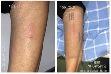 三发性静脉炎的预防措施有哪些,临床上如何预防化疗引起的静脉炎