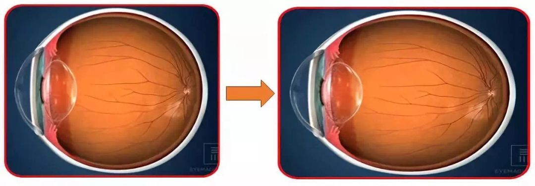 儿童近视矫正眼镜2000元,儿童近视弱视辅助治疗中心